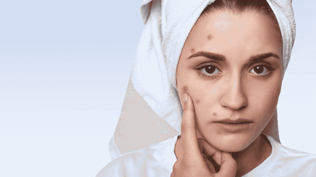 pakai handuk bikin jerawat